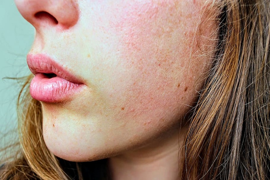 Comment prendre soin d’un épiderme fragile _